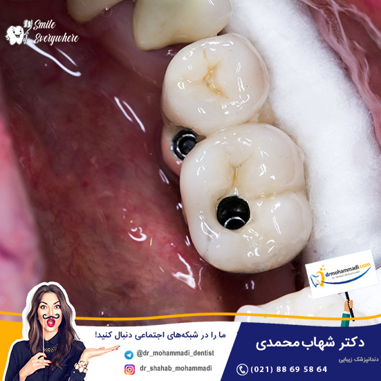 آیا ایمپلنت دندان درد دارد؟ - کلینیک دندانپزشکی دکتر شهاب محمدی